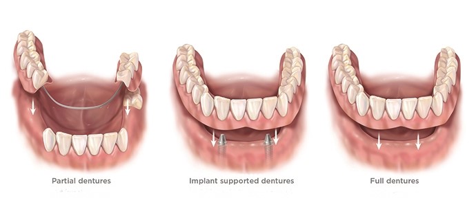 Before And After Dentures Genoa WV 25517